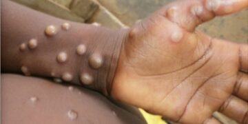 Monkeypox cases confirmed in 12 countries