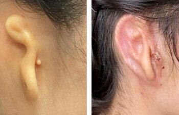 Woman implanted with 3D-printed ear made from her own cells