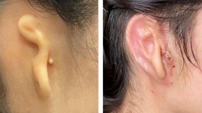 Woman implanted with 3D-printed ear made from her own cells