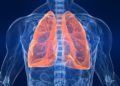 Researchers tests AI tool that predicts risk of lung cancer