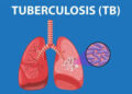 All Panchayats in Srinagar District declared TB-free
