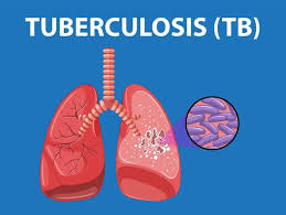 All Panchayats in Srinagar District declared TB-free