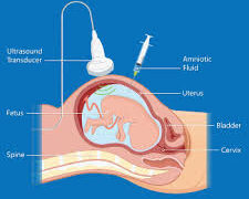 In a first, USG Guided Amniocentesis done in Lalla Ded hospital