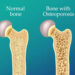 Sedentary lifestyle increases risk of osteoporosis, say doctors
