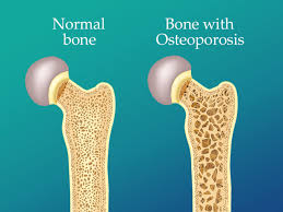 Sedentary lifestyle increases risk of osteoporosis, say doctors